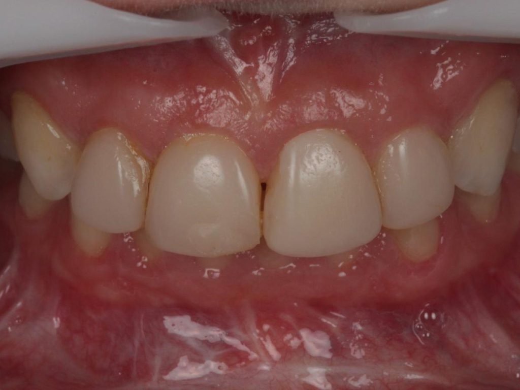 Comparação de sorriso de paciente do CROE
