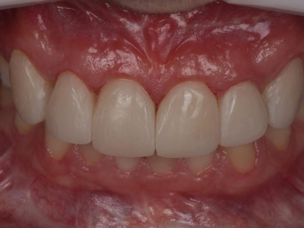Comparação de sorriso de paciente do CROE