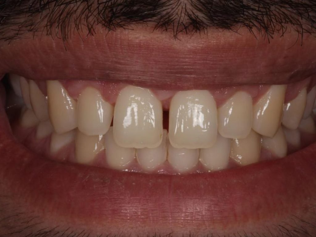 Comparação de sorriso de paciente do CROE
