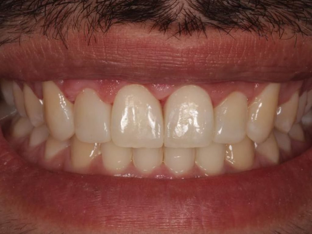 Comparação de sorriso de paciente do CROE