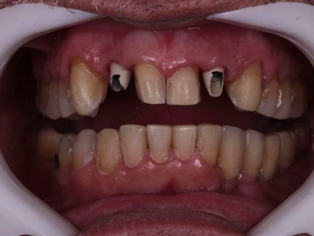 Comparação de sorriso de paciente do CROE