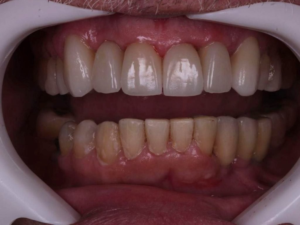 Comparação de sorriso de paciente do CROE