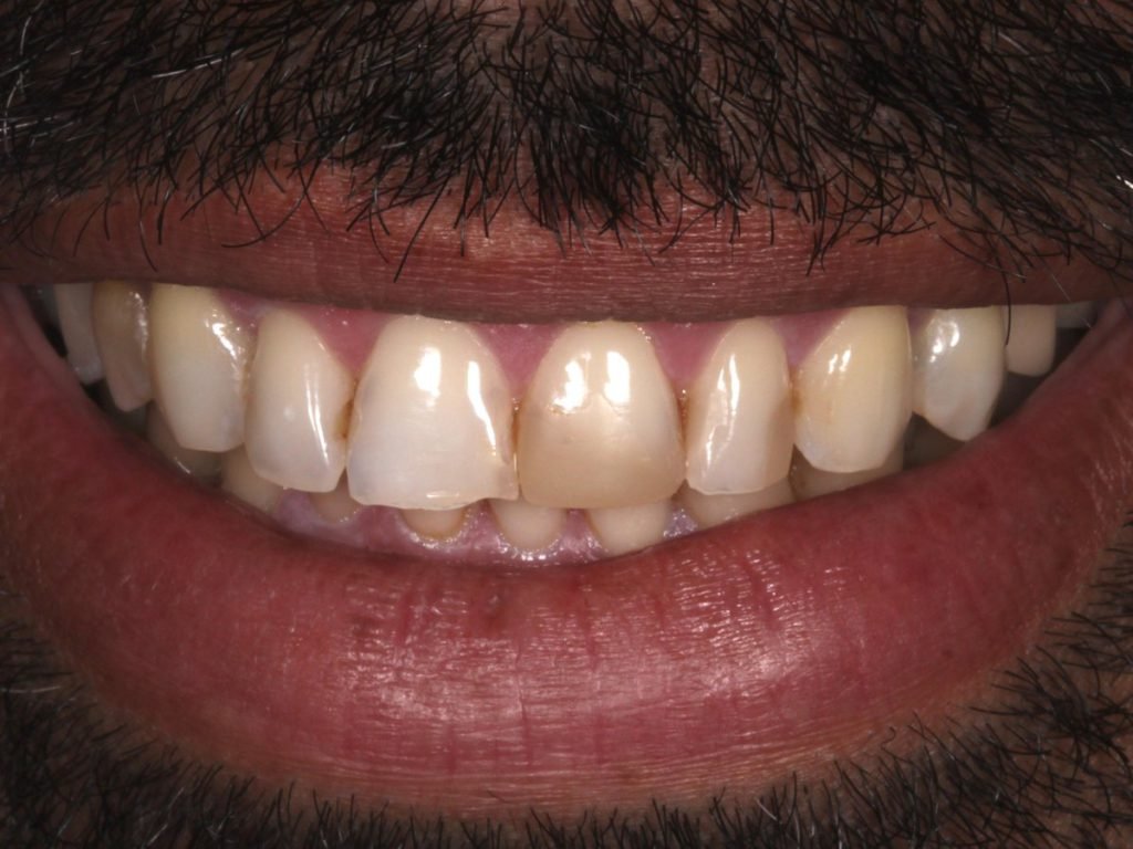 Comparação de sorriso de paciente do CROE