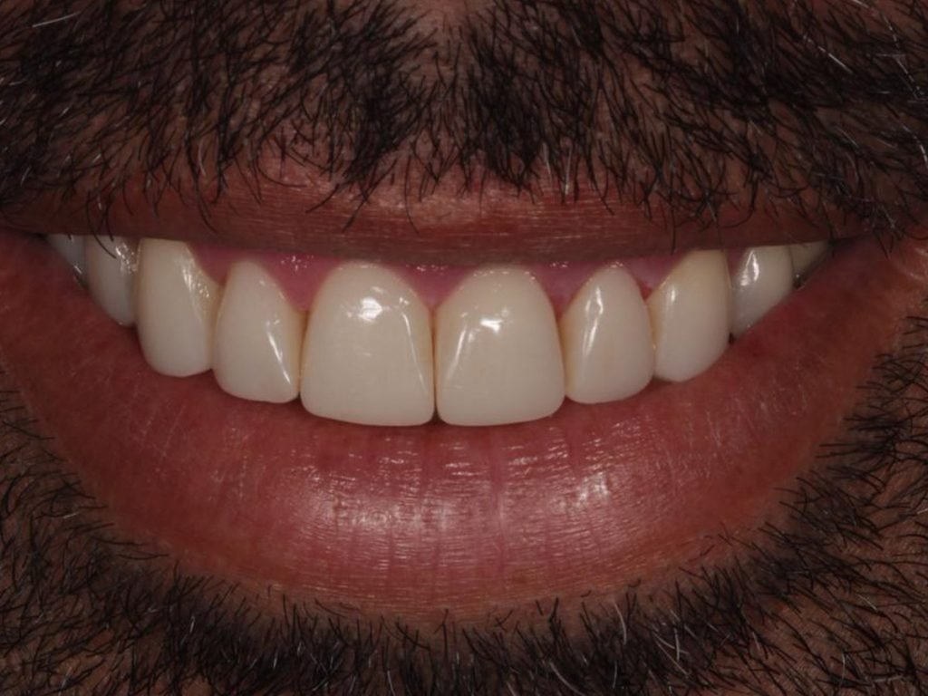 Comparação de sorriso de paciente do CROE