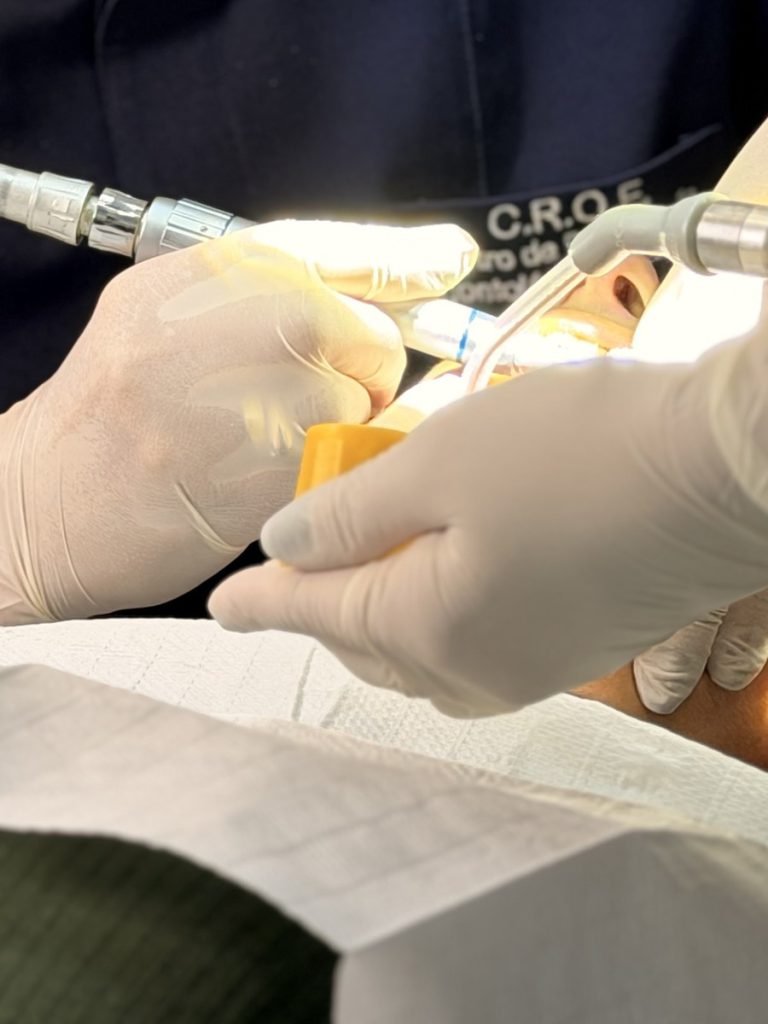 Mãos com luvas durante tratamento de canal, com caneta odontológica e isolamento