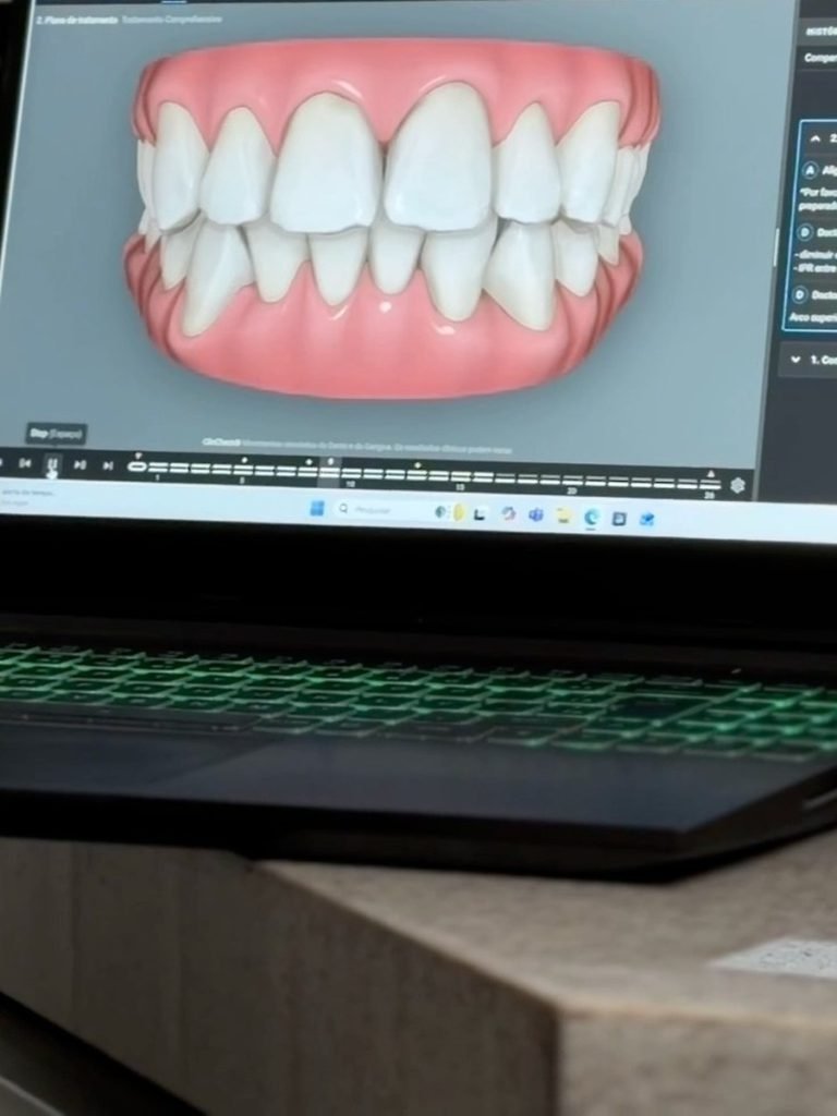 Planejamento digital Invisalign em 3D na tela do notebook